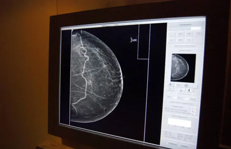 Exame para detetar o cancro da mama