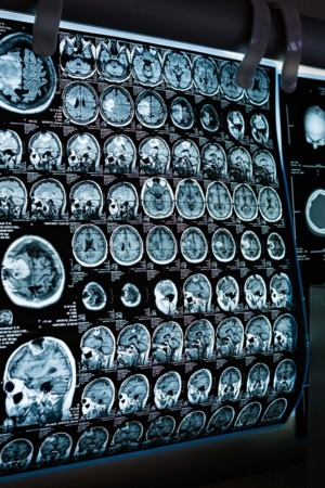 i3S replica tumores cerebrais pediátricos para novas terapias