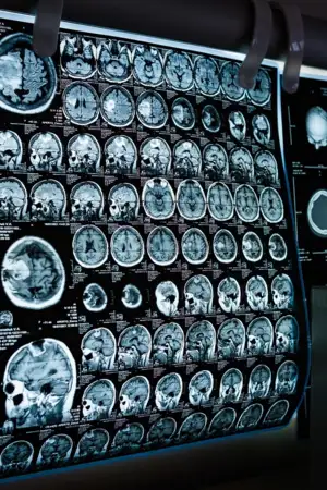 i3S replica tumores cerebrais pediátricos para novas terapias