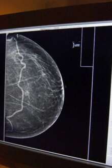 Exame para detetar o cancro da mama